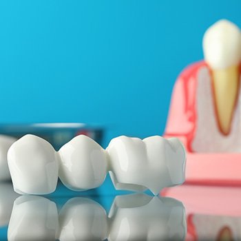 A closeup of a dental bridge with a dental implant model in the background