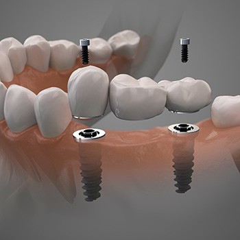 A 3D illustration of an implant bridge being placed